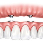 dental implants