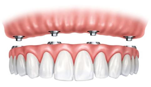 Dental implants stabilizing dentures