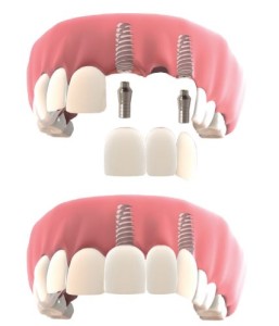 Multiple teeth restoration with dental implants