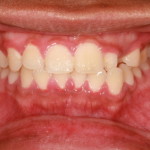 gingivitis leads to periodontal disease