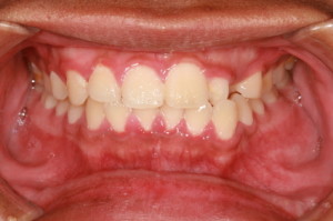 gingivitis leads to periodontal disease
