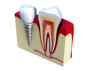 Anatomy of healthy teeth and dental implant in jaw bone.
