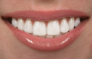 A Closer Look At Porcelain Veneers