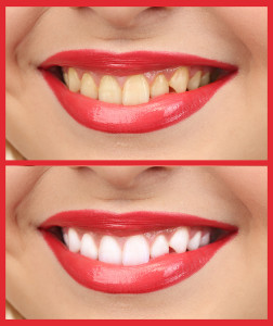 Is Professional Teeth Whitening Really Worth It?