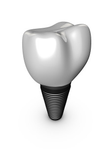 The Costs And Financing Of Dental Implants