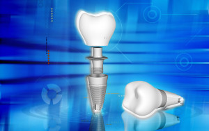 When Should You Consider Getting Dental Implants?