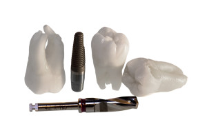 How To Care For Your Dental Implants