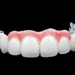 A Closer Look At Porcelain Veneers