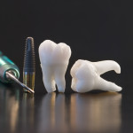 5 Big Reasons Dental Implant Surgery Is Worth Considering