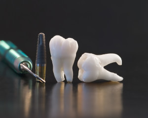 5 Big Reasons Dental Implant Surgery Is Worth Considering 