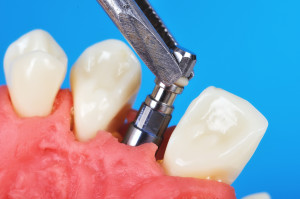 Are Dental Implants Worth The Cost?