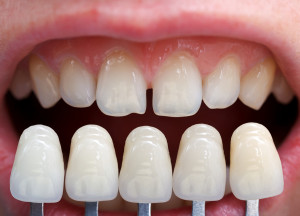 Show Your New Veneers Some Love