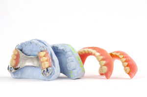 What You Should Know About Dentures
