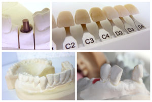 What Exactly Is Cosmetic Dentistry?