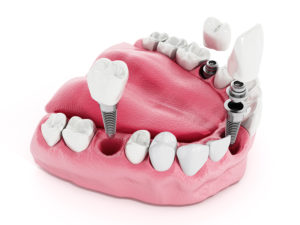 Top Reasons To Consider Dental Implants 