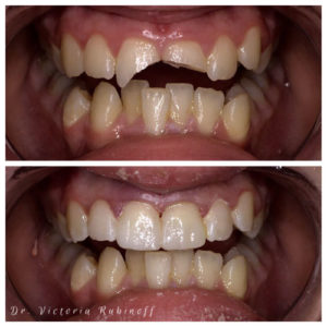 cosmetic dentistry before and after