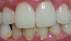 a mouth with gingivitis