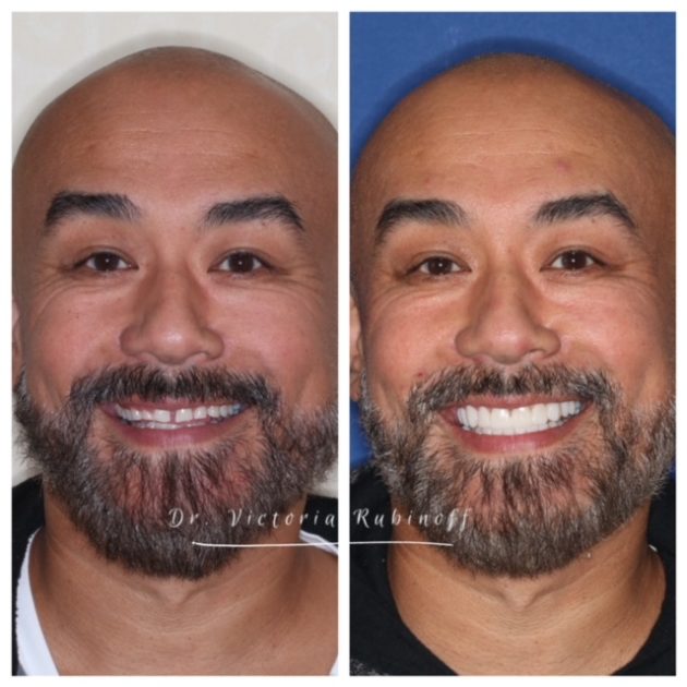 Cosmetic Dentistry before and after