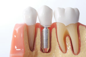 What You Might Not Know About Dental Implants