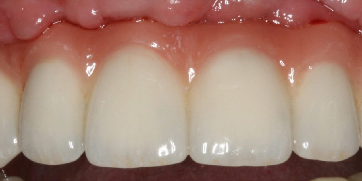 case 42 - after
