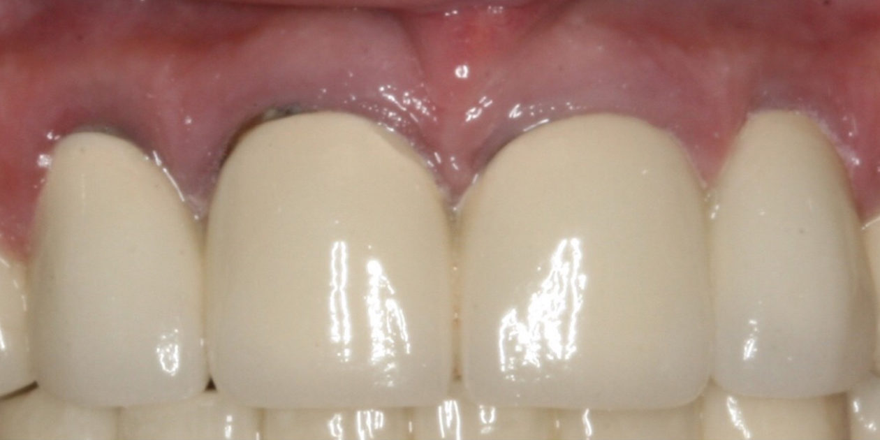 case 42 - before