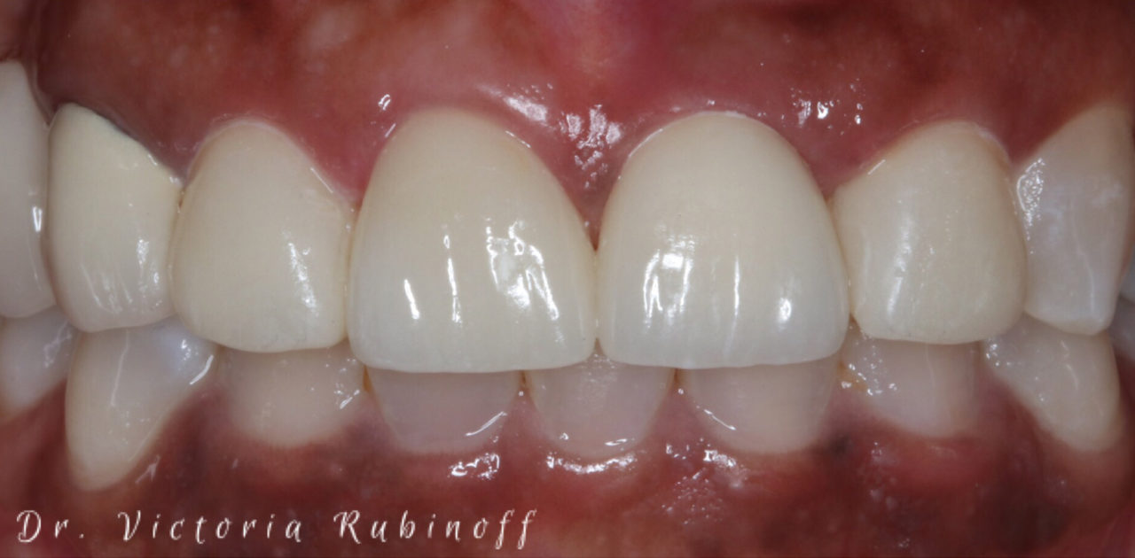 case 14 - after