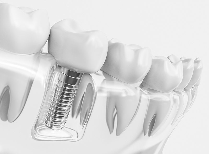 Tooth implant - 3D Rendering