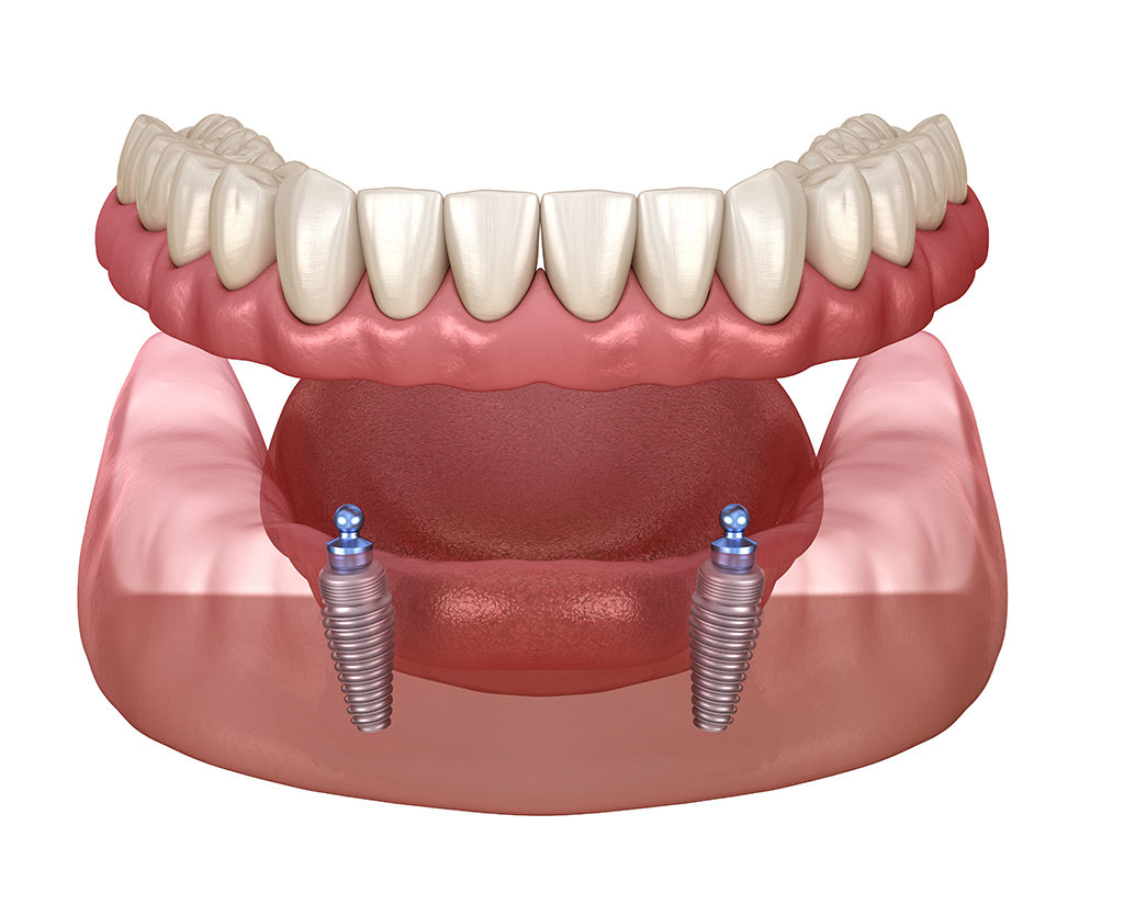 Dental Implants