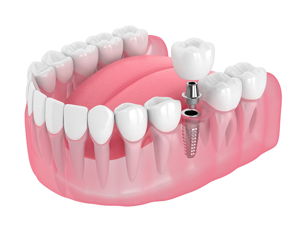 single tooth implant