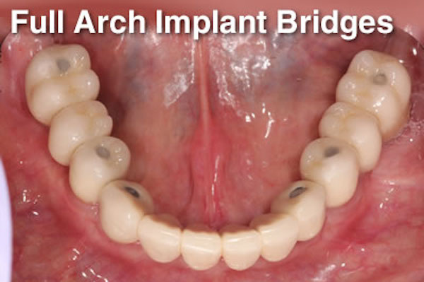 full arch implant bridges