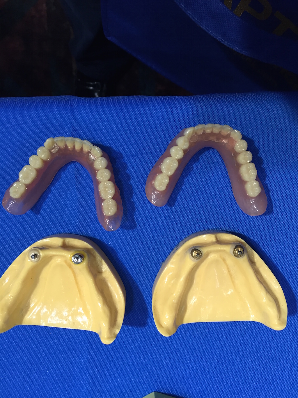 Implant Overdentures Upper Shine Dental Associates