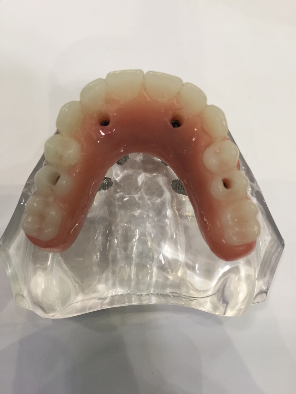 implant overdentures