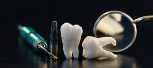 immediate implants