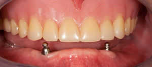 Implant Supported Over Dentures