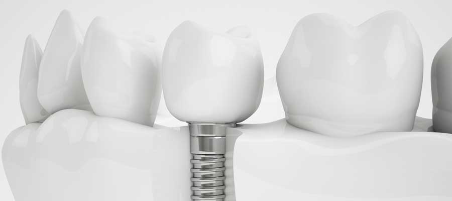 Screw Retained Permanent Dentures With Implants