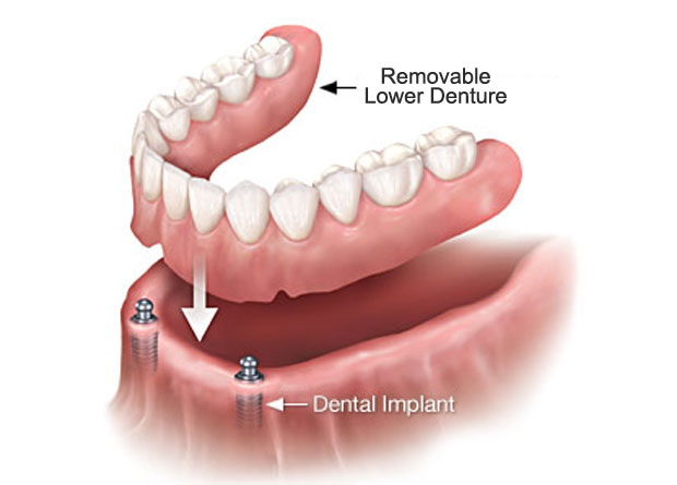 Implant Supported Over Dentures