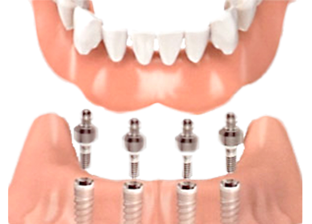 Mini Implant Supported Dentures