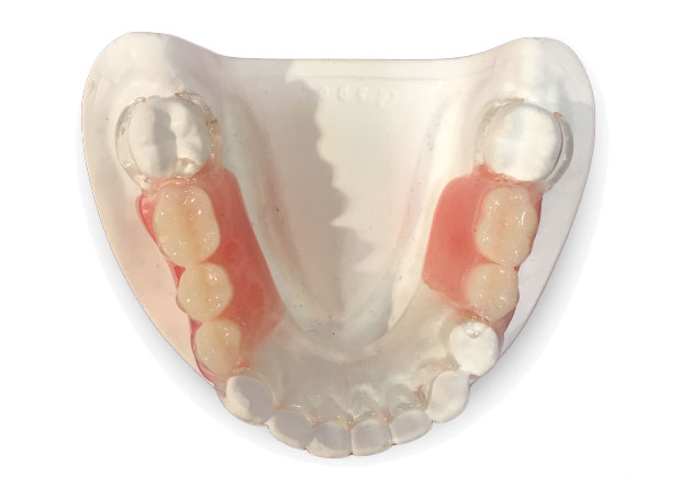 Partial Upper and Lower Dentures