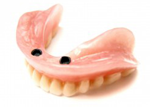 implant supported partial dentures