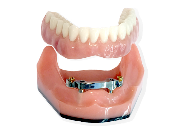 locator and bar supported over dentures