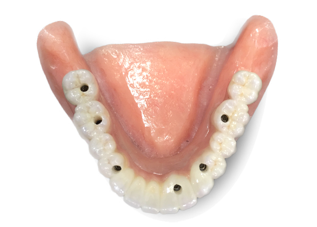 screw retained permanent dentures with implants