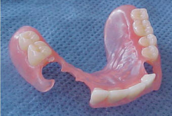 valplast partial lower dentures