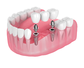 Teeth Replacement Options - implants multiple teeth