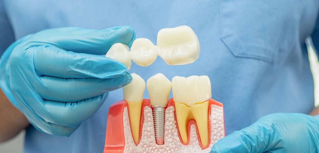 dental bridge at Shine Dental Associates in Syosset NY