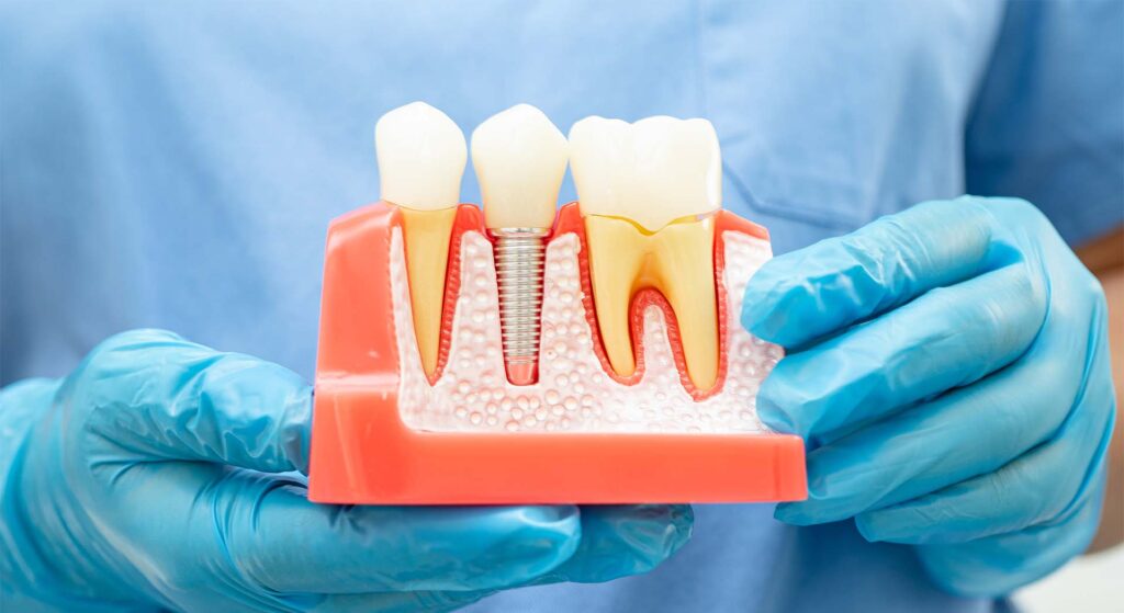 dental implants FAQs. Shine Dental Associates