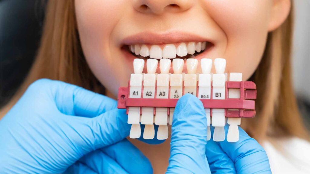 dental veneers at Shine Dental Associates