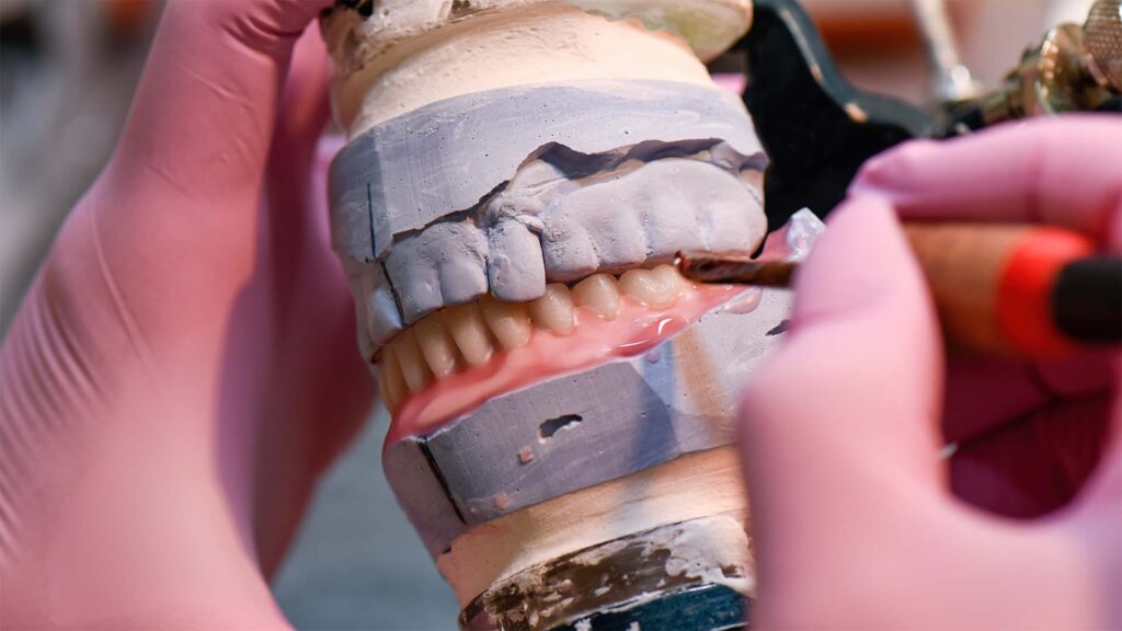 Denture Repairs and Relines at Shine Dental Associates