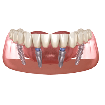 All-on-X dental implants​ Shine dental Long Island
