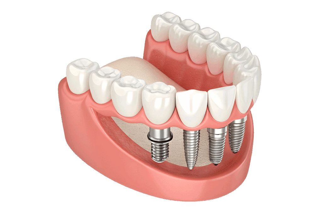 Implant Supported Denture Long Island