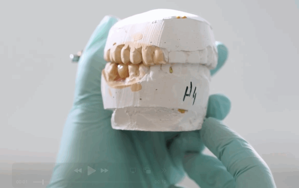 Denture partials made on site at Shine Dental Associates on Long Island